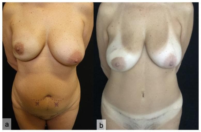 Clinical photograph comparison of a patient undergoing Deep Inferior Epigastric Perforator (DIEP) flap breast reconstruction. Panel (a) displays the preoperative state, showing clinical markings on the lower abdomen, including dotted lines and 'X' symbols, which identify superficial abdominal perforators and planned incision sites for the autologous tissue harvest. Panel (b) illustrates the eight-month postoperative results following right breast carcinoma resection via nipple-sparing mastectomy and bilateral reconstruction. Visible changes include a healed transverse scar across the suprapubic region and lower abdomen at the donor site, an improved abdominal contour, and reconstructed breast volume with maintained nipple-areolar complexes. The image demonstrates the 'gold standard' in autologous breast reconstruction, where abdominal skin and subcutaneous fat are transferred to the thorax to achieve a natural aesthetic result while minimizing donor site morbidity compared to traditional TRAM flap techniques. Target audience: Medical students and plastic surgery trainees.