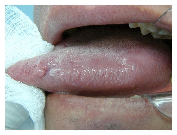 This clinical photograph displays a close-up, intraoral view of a human tongue, specifically focusing on the lateral border. The image depicts oral hairy leukoplakia (OHL), characterized by a non-removable, whitish, slightly elevated plaque with a corrugated or 'hairy' surface texture. The primary lesion is situated along the lateral margin, exhibiting vertical striations that are characteristic of this condition. Surrounding the main lesion are smaller, subtle areas of similar whitish discoloration against the normal pink, papillated mucosa of the tongue. The tongue is partially retracted with a gauze square for better visualization of the lateral aspect. This presentation is highly suggestive of Epstein-Barr virus (EBV) infection, often occurring in immunocompromised individuals, such as those with HIV/AIDS. The clinical focus illustrates the classic morphology and anatomical site preference (lateral tongue) for OHL, serving as an important diagnostic sign in oral pathology and infectious disease.