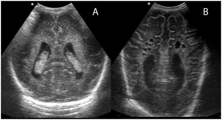 This diagnostic image consists of two coronal cranial ultrasound panels (A and B) demonstrating different grades of periventricular leukomalacia (PVL) in a neonatal brain. Panel A illustrates Grade 1 PVL, characterized by increased, relatively homogeneous echogenicity (echodensities) in the periventricular white matter surrounding the lateral ventricles. These bright regions are bilateral and lack cystic changes. Panel B demonstrates a more severe, cystic form of PVL (Grade 2 or higher). It reveals multiple discrete, small, anechoic (dark) fluid-filled cystic lesions within the periventricular regions where white matter necrosis has occurred. The lateral ventricles in Panel B appear irregular, and the surrounding brain parenchyma shows disrupted architecture compared to the solid echodensities in Panel A. These images are clinically significant for evaluating hypoxic-ischemic injury in preterm infants, showing the progression from transient echogenicity to permanent parenchymal loss and cavitation.