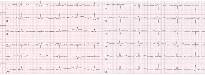 A standard 12-lead electrocardiogram (ECG) displayed on a traditional grid background, showing leads I, II, III, aVR, aVL, aVF, and V1 through V6. The tracing illustrates a consistent sinus rhythm with regular RR intervals. P waves are clearly visible preceding each QRS complex. The frontal plane leads (I, II, aVF) demonstrate predominantly upright QRS complexes, indicating a normal cardiac axis. In the precordial leads (V1-V6), there is appropriate R-wave progression from V1 to V6. The ST segments appear largely isoelectric across all leads without evidence of acute elevation or significant depression. T-wave morphology is varied, with upright T waves in most lateral and inferior leads, while V1-V3 show minor variations including flattening or inversion. This diagnostic image serves as an educational example of a baseline resting ECG for cardiovascular assessment, highlighting normal rhythm, axis orientation, and ventricular repolarization patterns.