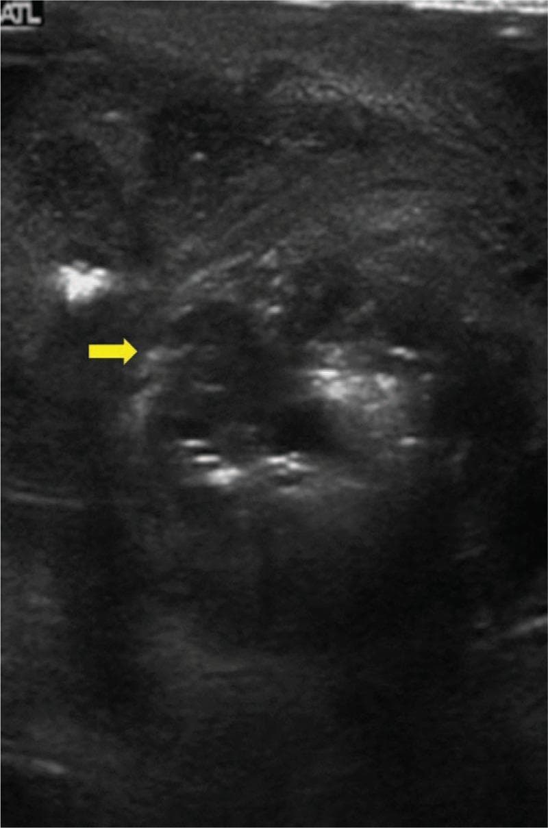 A greyscale diagnostic ultrasound image of the scrotum demonstrating emphysematous epididymo-orchitis. The testicular parenchyma exhibits a highly heterogeneous echotexture with a predominantly hypoechoic and grainy background. Multiple punctate, hyperechoic foci (bright spots) are scattered throughout the tissue, indicative of gas formation or micro-abscesses within the scrotal sac. A yellow arrow points to a cluster of these hyperechoic reflectors. Irregularly shaped hypoechoic areas suggest fluid collection or necrotic tissue consistent with abscess formation. The overall sonographic appearance indicates a severe inflammatory process, such as acute epididymo-orchitis complicated by gas-producing bacterial infection. This imaging is clinically relevant for diagnosing acute scrotal pathology and distinguishing uncomplicated infection from emphysematous changes requiring urgent surgical intervention.