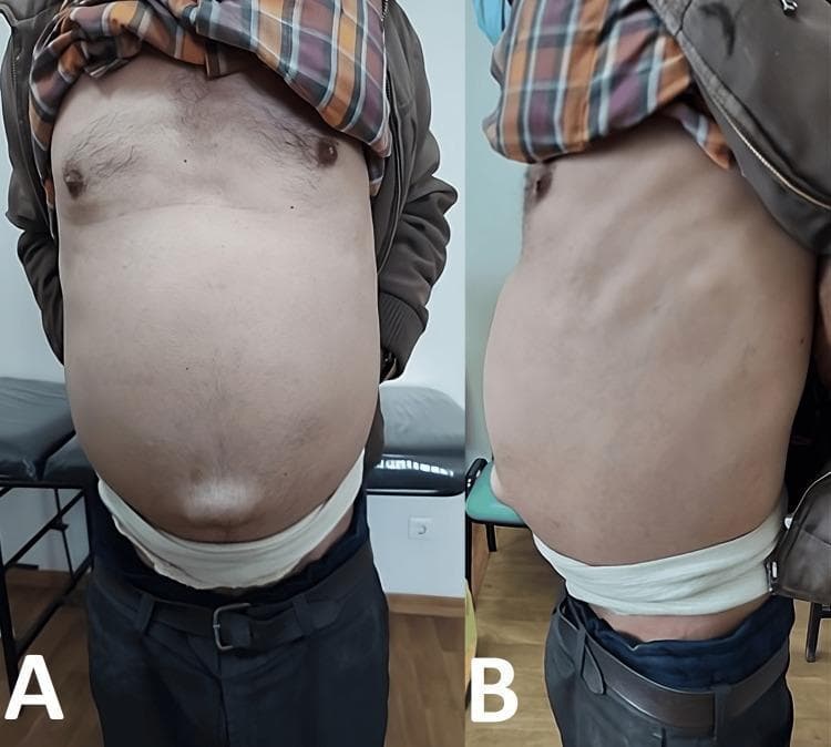 Clinical photograph showing the anterior (View A) and lateral (View B) profile of a patient's abdomen during physical examination. The image demonstrates massive abdominal distension, often associated with severe ascites or intra-abdominal masses. A prominent bulging umbilical hernia is clearly visible at the center of the abdominal wall. The skin appears taut and smooth due to the underlying pressure. A white support belt is positioned around the lower abdomen, used by the patient to provide structural stability and alleviate discomfort from the weight of the distended abdomen. This visual presentation is characteristic of pathology causing significant increase in intra-abdominal volume, such as Pseudomyxoma Peritonei (PMP), which leads to 'jelly belly' through the accumulation of mucinous fluid.