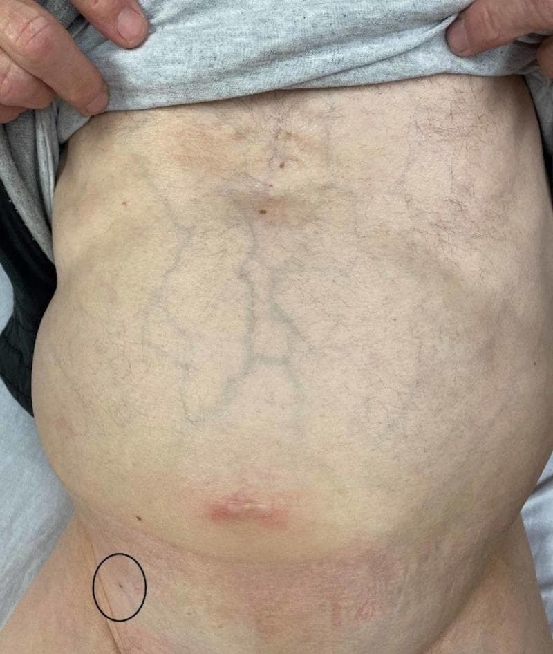 This clinical photograph shows a distended adult abdomen with several notable physical examination findings. Centrally, the abdomen displays prominent, dilated superficial veins, characteristic of caput medusae or collateral venous circulation often associated with portal hypertension. A red, linear scar or healing wound is visible in the lower midline (periumbilical region). A black circle in the patient's right lower quadrant highlights a small puncture site on the skin. This marked area represents a paracentesis site from three days prior, located medial to the right anterior inferior iliac spine. The skin within the circle shows a clean, dry puncture wound without evidence of active infection, such as surrounding erythema, swelling, or discharge. The overall clinical presentation illustrates a patient with likely ascites (suggested by the distention and venous patterns) and the follow-up appearance of a diagnostic or therapeutic paracentesis procedure. This image is relevant for gastroenterology and internal medicine education regarding the physical signs of chronic liver disease and post-procedural site assessment.