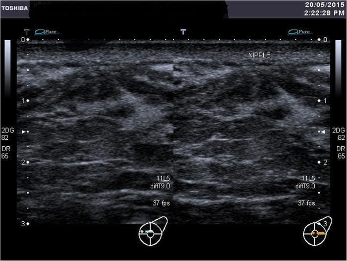 A grayscale diagnostic ultrasound image of the left breast in a postpartum patient, showing functional breast anatomy. The scan demonstrates a heterogeneous echotexture characteristic of lactating breast tissue, with a mix of hyperechoic glandular tissue and hypoechoic areas. Numerous dilated, hypoechoic linear and tubular structures are visible, representing lactiferous ducts. These ducts are oriented towards a focal point marked 'NIPPLE' at the superior aspect of the image, corresponding to the retroareolar region. The imaging highlights the presence of functional ductal systems even in clinical cases involving extensive external scarring (such as skin grafts). The ultrasound lacks the typical acoustic shadowing usually produced by a prominent nipple, reflecting the anatomical variation in this specific clinical case. Key educational features include the visualization of active milk-conducting ducts and the sonographic appearance of glandular tissue during the early postpartum/lactation phase.