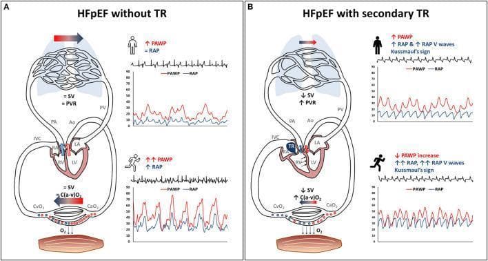 This pathophysiology diagram illustrates the hemodynamic differences between patients with heart failure with preserved ejection fraction (HFpEF) without tricuspid regurgitation (TR) (Panel A) and those with secondary tricuspid regurgitation (STR) (Panel B) during rest and exercise. The visual combines cardiovascular circuit diagrams with pressure tracings for pulmonary artery wedge pressure (PAWP) and right atrial pressure (RAP). In typical HFpEF (left), exercise triggers a steep increase in PAWP and a mild increase in RAP, maintaining relatively normal stroke volume (SV) and pulmonary vascular resistance (PVR). Conversely, HFpEF with STR (right) shows right atrial hypertension with prominent RAP V waves and Kussmaul's sign. Hemodynamic features in the STR group include a flatter PAWP rise during exercise, significantly reduced forward SV, and increased PVR, representing pulmonary vascular derecruitment and left ventricular underfilling. The diagram also highlights a greater reliance on peripheral oxygen extraction, indicated by a higher arteriovenous oxygen difference (C(a-v)O2) in the STR phenotype to compensate for low cardiac output during physical exertion.