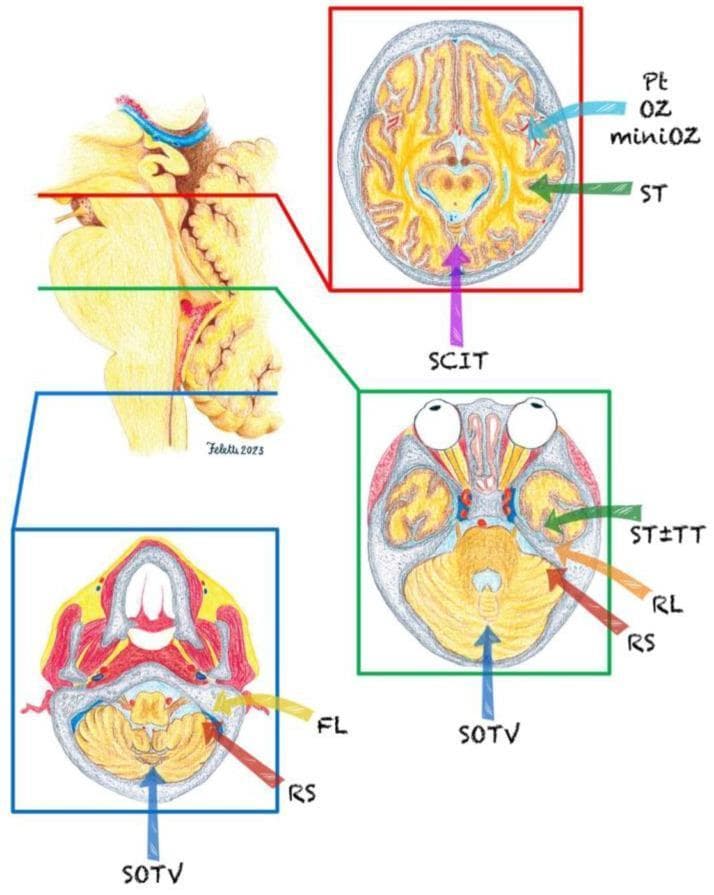 Anatomical and neurosurgical illustration depicting primary surgical approaches to the brainstem, segmented by axial planes. The left side of the image shows a sagittal view of the brainstem and cerebellum, color-coded into three main regions: the midbrain (red), the pons (green), and the medulla (blue). Three corresponding axial cross-sections are displayed on the right, mapped to these regions. The midbrain section (red frame) illustrates the Pterional (Pt), Orbitozygomatic (OZ/miniOZ), Subtemporal (ST), and Supracerebellar Infratentorial (SCIT) approaches. The pons section (green frame) demonstrates the Subtemporal (ST), Transtemporal (TT), Retrolabyrinthine (RL), Retrosigmoid (RS), and Suboccipital Transtelovelar (SOTV) routes. The medulla section (blue frame) highlights the Far Lateral (FL), Retrosigmoid (RS), and Suboccipital Transtelovelar (SOTV) trajectories. Arrows indicate the surgical vectors relative to the neuroanatomy, including the cerebellum, brainstem nuclei, and surrounding cranial structures, serving as a guide for selecting operative corridors based on lesion localization within the brainstem.