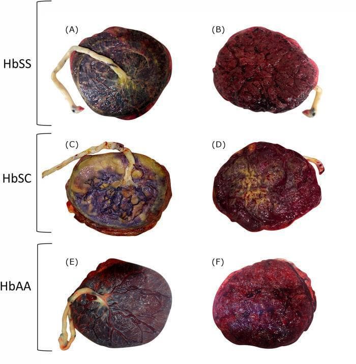 This clinical photograph displays a comparative gross pathological examination of human placentas categorized by maternal hemoglobin genotype: sickle cell anemia (HbSS), sickle cell hemoglobin C disease (HbSC), and normal adult hemoglobin (HbAA/Control). The image is arranged in a grid showing both fetal sides (left column: A, C, E) and maternal sides (right column: B, D, F).
Panels A and B (HbSS): The fetal side shows prominent, congested vasculature and subchorionic fibrin deposition. The maternal side exhibits a deep, dusky red color with a rough, nodular texture.
Panels C and D (HbSC): These display significant gross abnormalities, including extensive yellowish-white plaques of subchorionic fibrin deposition covering approximately 50% of the fetal surface. The maternal side shows lighter, gritty areas indicative of calcifications.
Panels E and F (HbAA): The control placenta shows a healthy, glistening fetal surface with distinct, regular branching vessels and a uniform, dark red maternal surface with smooth cotyledons.
This comparison illustrates placental manifestations of Sickle Cell Disease (SCD), highlighting pathological changes such as increased fibrin deposition and calcification associated with maternal hematological conditions.