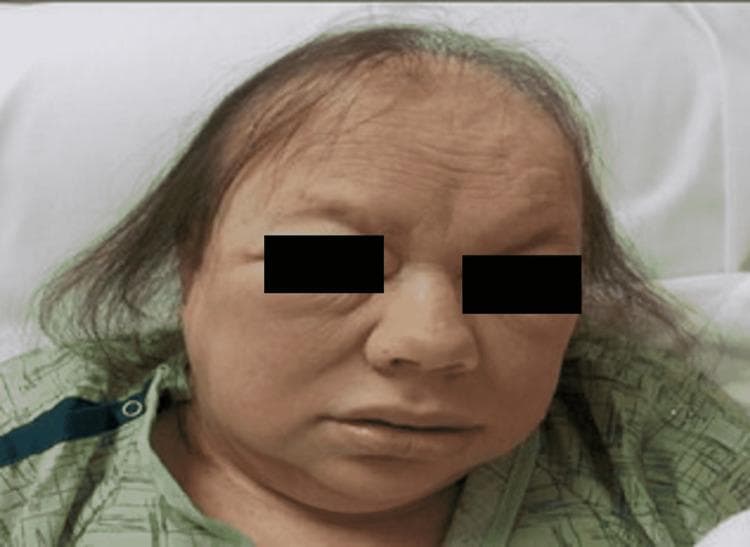 A clinical photograph of a patient's face and head, demonstrating classic features of myxedematous facies associated with severe hypothyroidism or myxedema coma. The patient exhibits generalized facial puffiness and non-pitting edema, particularly prominent in the periorbital and cheek regions. The skin appears pale, thickened, and somewhat waxy with visible forehead wrinkling. Significant dermatological findings include diffuse thinning of the scalp hair (alopecia) and the characteristic loss of the outer third of the eyebrows (Madarosis). The overall facial expression is dull or apathetic, which is typical for this metabolic state. This image serves as an educational reference for identifying the systemic physical manifestations of advanced thyroid hormone deficiency in a clinical setting.