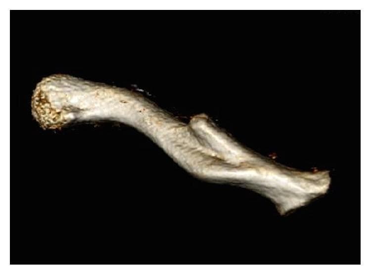 This diagnostic image is a 3D CT reconstruction of a left clavicle, viewed from a posterior perspective against a black background. The image illustrates a significant orthopedic deformity characterized by a malunited midshaft clavicular fracture. The anatomical structure shows a clear disruption of the normal S-shaped contour, with the distal end of the proximal fracture fragment protruding posteriorly, creating a sharp bony prominence and overall angulation. The surface morphology of the bone varies from the smooth, bulbous appearance of the medial end to a rough, irregular texture at the site of bony callus formation and remodeling. This visualization is clinically significant for demonstrating how clavicular malunion can result in posterior displacement, potentially leading to neurovascular complications such as impingement on the subclavian artery or brachial plexus. The content is suitable for orthopedic and radiological educational curricula focusing on fracture healing, malalignment, and thoracic outlet anatomy.