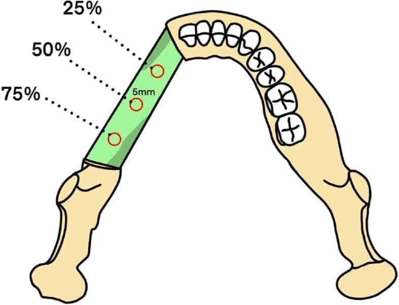 This medical anatomical diagram illustrates a fibula free flap graft integrated into a maxillary or mandibular arch for jaw reconstruction. The diagram shows a green-shaded segment representing the transplanted fibula bone flap positioned between existing segments of the jawbone, which include representations of the teeth and ramus. Three circular Regions of Interest (ROIs), each with a diameter of approximately 5 mm, are indicated along the longitudinal axis of the fibula graft. These ROIs are positioned at three distinct points: 25%, 50%, and 75% of the graft's total length. The illustration demonstrates the standardized methodology for measuring clinical parameters such as Hounsfield Unit (HU) values and Bone Mineral Density (BMD) to assess bone quality, graft integration, and potential resorption during post-operative follow-up. This visualization is intended for maxillofacial surgery and radiology education, highlighting the objective monitoring of reconstructive surgery outcomes.