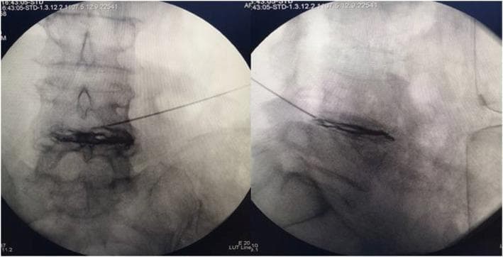 This diagnostic image displays dual-pane intraoperative C-arm fluoroscopy views (anteroposterior and lateral) of the lumbar spine during a minimally invasive spinal procedure. The images demonstrate the precise positioning of a radiofrequency (RF) puncture needle within an intervertebral disc space. In the anteroposterior (AP) view on the left, the needle tip is centered over the disc, with contrast medium appearing as a dark, radiopaque area spreading horizontally within the nucleus pulposus and toward the annulus fibrosus. The lateral view on the right confirms the depth of the needle tip within the center of the disc space, showing the longitudinal distribution of the contrast agent along the superior and inferior vertebral endplates. These images are clinically significant for verifying needle placement and contrast spread during intradiscal radiofrequency thermocoagulation or discography for the treatment of lumbar disc herniation. The modality is fluoroscopic guided intervention, highlighting anatomical landmarks including vertebral bodies, pedicles, and the intervertebral disc interval.