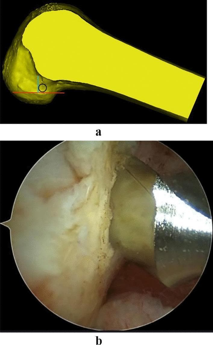 This composite image illustrates the surgical planning and intraoperative execution of femoral tunnel positioning during Anterior Cruciate Ligament (ACL) reconstruction.
Panel A presents a 3D anatomical diagram of the distal femur. A red horizontal line marks the lowest point of the femoral cartilage margin. A blue vertical line extends from this base, perpendicular to the tibial plateau orientation. A black circle, representing a hollow drill, is placed tangential to both lines to identify the I.D.E.A.L. femoral tunnel entry point.
Panel B shows a corresponding intraoperative arthroscopic view of the knee joint. The image captures the surgical field where the lateral femoral condyle is visible. A metallic surgical instrument, specifically a hollow drill or guide, is positioned against the bone surface to begin the creation of the femoral bone tunnel. This visual demonstrates the clinical application of the 'high flexion femur preservation' positioning method, ensuring anatomical graft placement relative to the femoral condylar landmarks and resident ACL stumps.