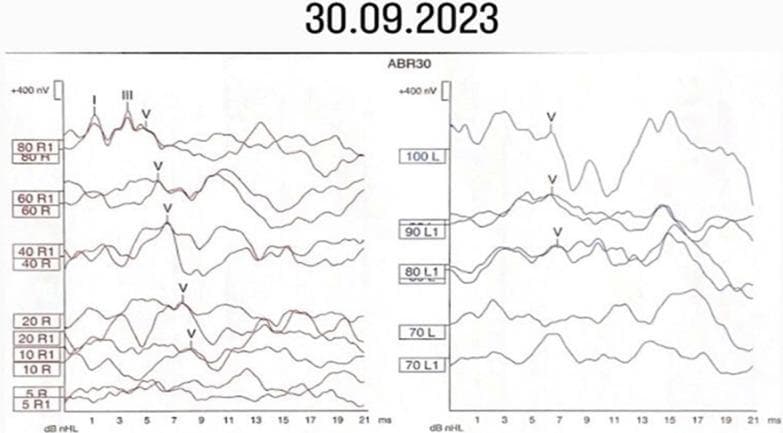 This diagnostic image displays the wave morphologies of an Auditory Brainstem Response (ABR) test, showing objective electrophysiological data for both the right (R) and left (L) ears. The ABR traces represent neural activity along the auditory pathway from the cochlear nerve to the brainstem. The right ear traces show well-defined, reproducible wave peaks (labeled I, III, and V) down to lower intensities, with Wave V identifiable at 10 dB nHL, indicating normal hearing sensitivity and neural synchrony. In contrast, the left ear traces exhibit significant distortion and poor wave morphology. While Wave V is identified at higher intensities (70-100 dB nHL), earlier waves (I and III) are absent or poorly defined, and the latency of Wave V appears delayed compared to the right side. This side-by-side comparison demonstrates a pathological response in the left ear, consistent with sensorineural hearing loss and impaired neural conduction. The x-axis represents time in milliseconds (ms), and the y-axis shows amplitude in nanovolts (nV).