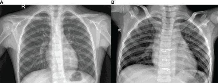 This comparative diagnostic image features two posterior-anterior (PA) chest radiographs (labeled A and B) illustrating the radiological differences between healthy and diseased lungs. Image A represents a healthy chest X-ray, demonstrating clear, radiolucent (dark) lung fields with normal vascular markings. The cardiac silhouette, costophrenic angles, and diaphragmatic contours are sharply defined. Image B shows a chest X-ray characteristic of pneumonia, exhibiting diffuse, multifocal opacities and patchy infiltrates throughout the lung parenchyma, particularly in the middle and lower zones. These findings represent pulmonary consolidation and fluid accumulation. A distinctive feature in Image B is the presence of radio-opaque surgical staples along the midline of the thoracic spine, likely representing prior surgical intervention. Both images display standard thoracic anatomy, including the rib cage, clavicles, humeri, and vertebral column. This visual comparison is used in medical education to teach the identification of pulmonary infections and the recognition of radiological signs such as infiltrates and obscured heart borders.