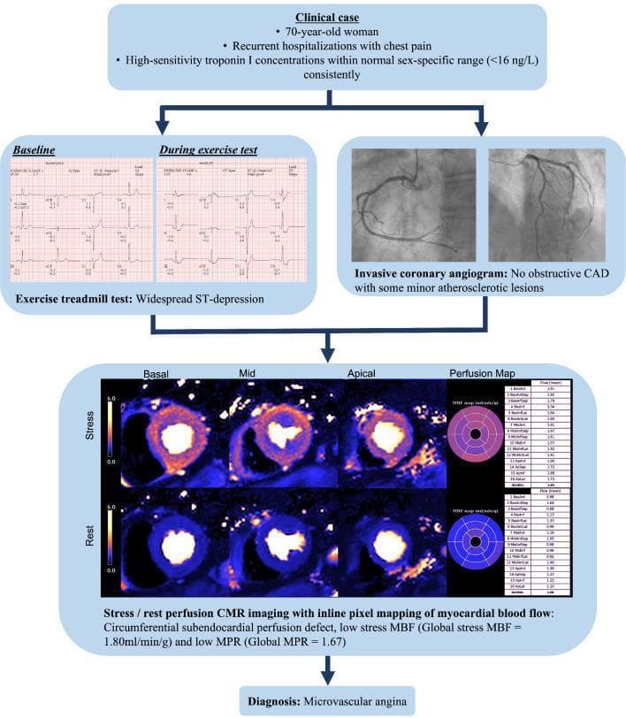 This composite educational graphic illustrates a clinical case of ischemia with non-obstructive coronary artery disease (INOCA), specifically microvascular angina. The presentation begins with clinical data from a 70-year-old female patient with recurrent chest pain and normal high-sensitivity troponin I. Diagnostic evidence is provided through four modalities. Top left: Exercise treadmill test strips comparing 'Baseline' to 'During exercise test,' showing widespread horizontal ST-segment depression indicative of inducible ischemia. Top right: Invasive coronary angiograms (ICA) of the right and left coronary arteries showing no obstructive coronary artery disease (CAD), only minor atherosclerotic plaque. Bottom: Stress/Rest perfusion Cardiac Magnetic Resonance (CMR) imaging with pixel-based myocardial blood flow (MBF) mapping. The short-axis basal, mid, and apical stress images demonstrate a circumferential subendocardial perfusion defect (darker blue/purple areas) compared to rest images. A quantitative perfusion map and data table accompany the CMR, reporting a low global stress MBF of 1.80 mL/min/g and a myocardial perfusion reserve (MPR) of 1.67. The collective evidence leads to the final diagnosis of microvascular angina.