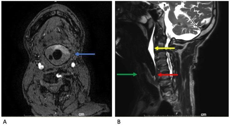 This diagnostic imaging composite displays a comparison of an i-gel supraglottic airway device in situ via MRI. Image A is a horizontal MRI angiography section showing the i-gel (blue arrow) creating a complete, circular seal within the hypopharynx. The central lumen of the device appears as a low-signal (dark) circular void, surrounded by the intermediate-signal material of the device's cuff, which interfaces tightly with the surrounding pharyngeal soft tissues. Image B is a T2-weighted sagittal MRI of the cervical spine and airway. It illustrates the spatial relationship of the device: the glottis is marked by a green arrow, the high-signal (bright) accumulation of saliva is sequestered posterior to the tongue and superior to the device cuff (yellow arrow), and the distal tip of the i-gel is positioned near the upper esophageal sphincter (red arrow). The images demonstrate the device's anatomical fit, airway patency, and effective separation of secretions from the laryngeal inlet, which is critical for airway management during general anesthesia in the MRI suite.