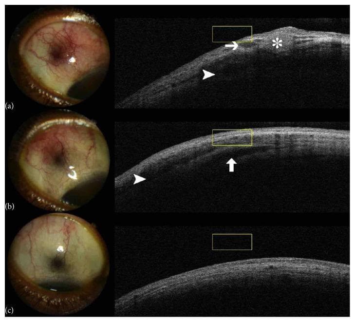 A longitudinal comparison series showing the clinical progression of tuberculous nodular episcleritis and anterior scleritis in the right eye. The image is structured into three temporal stages (a, b, c), each paired with a slit-lamp photograph and a corresponding anterior segment optical coherence tomography (AS-OCT) scan. Stage (a) displays intense superotemporal sector hyperaemia, a subconjunctival nodule, and violaceous injection; AS-OCT reveals a hyperreflective episcleral nodule (asterisk) and hyporeflective spaces indicating subepiscleral (arrow) and scleral (arrowhead) oedema. Stage (b), following initiation of antituberculous chemotherapy, demonstrates reduced hyperaemia and clinical resolution of the nodule, though AS-OCT shows persistent hyporeflective intrascleral spaces (arrow) and subepiscleral oedema (arrowhead). Stage (c), upon completion of therapy, shows total clinical remission with no hyperaemia and a restored, healthy anatomical structure on AS-OCT with complete elimination of prior lesions. This comparison illustrates the utility of AS-OCT in monitoring deep tissue resolution of inflammatory eye disease that may persist after superficial clinical signs have improved.