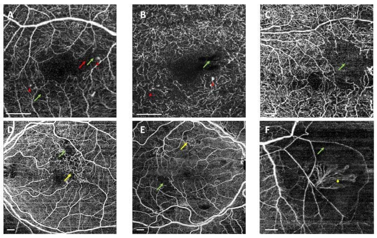 This set of six panels (A-F) presents Swept-Source Optical Coherence Tomography Angiography (SS-OCTA) images of the human retina, illustrating various microvascular complications associated with diabetic retinopathy. Panels A and B display 3x3 mm scans of the superficial and deep capillary plexuses, highlighting an irregular foveal avascular zone (FAZ) (red arrows) and small, hyper-reflective microaneurysms (red arrowheads). Panel C, a 6x6 mm scan, demonstrates significant areas of capillary nonperfusion (green arrows) in the temporal macular region. Panels D and E (9x9 mm and 6x6 mm scans) showcase intraretinal microvascular abnormalities (IRMAs), visible as dilated, looping vessels (yellow arrows) adjacent to areas of impaired perfusion. Panel F illustrates proliferative diabetic retinopathy findings, specifically retinal neovascularization elsewhere (NVE) (yellow arrowhead), appearing as a cluster of fine, abnormal branching vessels originating from a retinal vein. These images serve as educational examples for identifying diagnostic markers such as FAZ remodeling, capillary dropout, and pathologic angiogenesis using non-invasive depth-resolved imaging.