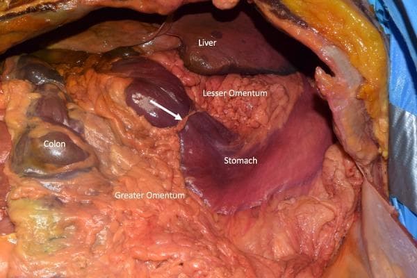 Anterior clinical photograph of a cadaveric abdominal dissection displaying a rare anatomical variation. The image shows the superiorly positioned liver, with the stomach located inferiorly and to the anatomical left. A textured lesser omentum (hepatogastric ligament) connects the liver and stomach, while the fat-laden greater omentum hangs from the stomach's greater curvature. A distinct, anomalous band (indicated by a white arrow) is visible, extending from the lesser omentum to the greater omentum. This band crosses the anterior surface of the distal stomach, creating a mechanical constriction or hourglass deformity. To the left of the image, portions of the colon are visible. The primary educational focus is the identification of anomalous peritoneal bands and their potential to cause gastric compression or obstruction in clinical scenarios.