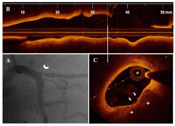 This composite figure demonstrates diagnostic imaging of the coronary arteries in a patient with unstable angina pectoris (UAP). Figure A is a coronary angiography (CA) frame showing the left coronary system, with a white arrowhead identifying a hazy, eccentric plaque at the ostium of the left anterior descending (LAD) artery. Figure B and C provide high-resolution intravascular imaging using optical coherence tomography (OCT). Figure B displays a longitudinal reconstructed view of the LAD plaque over a 50mm segment. Figure C shows a cross-sectional OCT view of the ostial LAD, revealing a plaque with an area stenosis of 38%. The image highlights plaque erosion with superficial calcific plaque (PE-SCP), marked by white stars, which is overlaid by white thrombi, indicated by white arrows. An OCT imaging catheter is centered within the vessel lumen. This set of images illustrates the clinical utility of combining luminal angiography with intravascular OCT to characterize vulnerable plaque morphology, such as calcific erosion and associated thrombosis, in acute coronary syndromes.