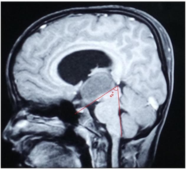 Midsagittal MRI of an 8-year-old boy demonstrating a purely intraventricular craniopharyngioma. The image reveals a large, well-circumscribed, mixed-signal mass within the third ventricle, causing inferior bulging of the ventricular floor and significant mass effect on the hypothalamus and suprasellar region. The overlying lateral ventricles show signs of hydrocephalus. Superimposed red lines illustrate the measurement of the Mamillary Body Angle (MBA), recorded here at 60 degrees. This angle is formed by the intersection of a plane tangential to the base of the mamillary body and a plane tangential to the fourth ventricular floor. Key anatomical landmarks visible include the corpus callosum, brainstem, cerebellum, and the patent suprasellar cistern, which remains distinct from the inferior boundary of the tumor. The optic chiasm is displaced downward, a hallmark of strictly intraventricular lesions. This radiological presentation is used to differentiate purely intraventricular tumors from those with primary suprasellar origins.