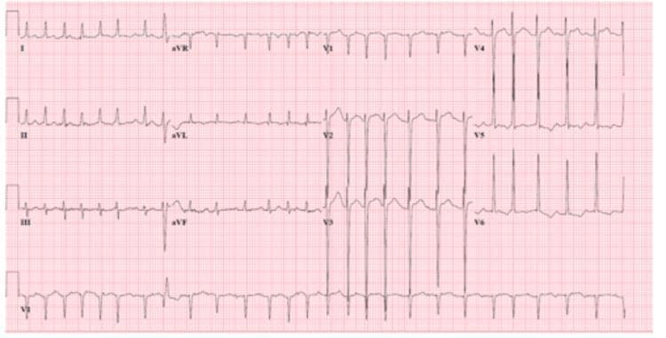 A standard 12-lead electrocardiogram (ECG) tracing on pink grid paper depicting atrial fibrillation (AFib) with a rapid ventricular rate (RVR). Key diagnostic features include the total absence of discernible P waves and an 'irregularly irregular' rhythm, characterized by varying R-R intervals between narrow QRS complexes. Fine fibrillatory (f) waves are visible along the baseline, most notably in lead V1. The heart rate is tachycardic, with QRS complexes occurring in rapid succession, particularly prominent in the precordial leads V4 through V6. Morphology of the QRS complexes and T waves shows minor beat-to-beat variability secondary to the irregular rhythm. The tracing serves as a classic clinical example of supraventricular tachyarrhythmia, highlighting the hallmark electrical characteristics used to differentiate AFib from sinus tachycardia or atrial flutter in a cardiovascular or emergency medicine context.