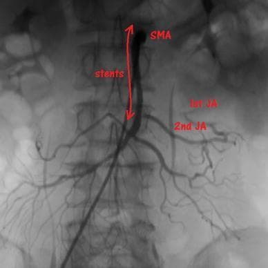 This diagnostic image is an abdominal angiogram (digital subtraction angiography) highlighting the mesenteric vasculature. The superior mesenteric artery (SMA) is the central vessel of interest, showing the placement of two endovascular stents extending from the proximal to the mid-portion of the artery. Red annotations and a double-headed arrow delineate the stented segment. Branching distally from the SMA, the first jejunal artery (1st JA) and second jejunal artery (2nd JA) are visible. The 2nd JA demonstrates robust contrast filling, whereas the 1st JA exhibits diminished perfusion in its distal marginal branches, suggesting localized ischemia or compromised flow despite SMA recanalization. The image illustrates the management of acute mesenteric ischemia (AMI) via thrombectomy and secondary stenting for atherosclerotic stenosis or thrombosis. The vascular anatomy is projected against the lumbar vertebrae, with bowel gas visible in the background. This visual serves as a clinical case for interventional radiology and vascular surgery, focusing on SMA stenting outcomes and collateral circulation patterns in the small intestine.