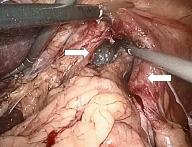 This endoscopic clinical photograph depicts an intraoperative view of a hiatal hernia repair procedure. The surgical field highlights the dissection and preparation of the esophageal hiatus. Two white arrows indicate the right and left crura of the diaphragm, which have been prepared in their ventral aspect, revealing the striated muscular texture of the diaphragmatic tissue. Centrally located between the crura is a dark, smooth-textured mass representing the hiatal sac being mobilized. Metallic laparoscopic surgical instruments are visible in the upper quadrants, manipulating the surrounding tissues. The surrounding anatomical structures show signs of active surgical dissection, including exposed tissue planes and minor localized hemorrhage. The view demonstrates the necessary anatomical exposure of the mediastinal opening required for reduction of hernia contents and subsequent hiatoplasty.
