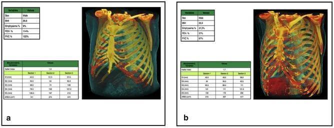 This diagnostic comparison uses 3D CT reformations and morphometric data to demonstrate rib cage remodeling in Chronic Obstructive Pulmonary Disease (COPD). Image A shows a normal rib cage of a 58-year-old male smoker with 0% emphysema, characterized by an elongated, conical shape with a relatively narrow upper aperture and gradual lower expansion. Image B illustrates a 61-year-old male with severe emphysema (37.2%) exhibiting a classic 'barrel chest' configuration. Key morphologic changes in the COPD model include a significant increase in upper rib cage dimensions (larger transverse and anteroposterior diameters) and a relative decrease in lower rib cage area compared to the control. The ribs in the emphysematous chest show a more horizontal orientation and increased curvature, reflecting hyperinflation and mechanical displacement of the thoracic wall. Accompanied tables provide quantitative variables, including Haller index, sectional diameters (D1-D5), and cross-sectional areas, correlating visual remodeling with objective functional decline (decreased FEV1/FVC ratios).
