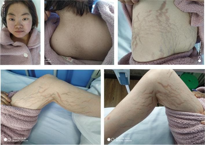 A composite of five clinical photographs illustrating the classic physical manifestations of Cushing's syndrome in a 26-year-old female. The top-left image shows a frontal view of the face, demonstrating a 'moon face' appearance characterized by a rounded facial contour and prominent, plethoric (flushed) cheeks. The top-center photograph displays the posterior cervical and upper thoracic region, showing a significant dorsocervical fat pad, commonly referred to as a 'buffalo hump.' The remaining three images (top-right, bottom-left, and bottom-right) focus on the patient's trunk and limbs, revealing wide, violaceous (purplish) striae distensae across the abdomen and thighs. These striae appear as deep, linear streaks indicating thinning of the dermis. Collectively, these visual findings are hallmark cutaneous and structural signs of chronic hypercortisolism, which in this clinical context was secondary to a left adrenal adenoma. The images serve as educational references for endocrinology and dermatology, highlighting the systemic physical changes associated with cortisol excess.