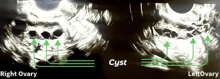 This diagnostic image consists of a grayscale pelvic ultrasound sonography (USG) displaying bilateral ovaries in a female patient. The image is split into two panels, with the right ovary on the left and the left ovary on the right, both exhibiting a speckled stroma. Within the ovarian tissue of both structures, there are multiple anechoic (dark), circular, and ovoid fluid-filled structures identified as cysts. Green arrows highlight these cysts, which vary in size and are scattered throughout the stroma. The appearance is clinically consistent with polycystic ovary syndrome (PCOS) or multifollicular ovaries, where the internal structure shows an increased number of follicles/cysts. The image serves as an educational tool for identifying common sonographic markers of ovarian pathology and follicular monitoring in reproductive medicine.