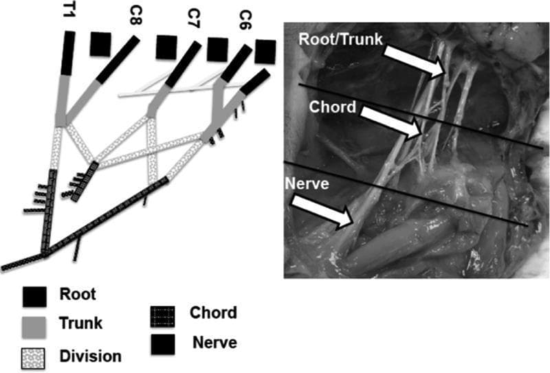 This composite educational material consists of a schematic diagram and a corresponding intraoperative clinical photograph illustrating the anatomical segments of the brachial plexus. The schematic on the left delineates the progression from spinal nerve roots (C6, C7, C8, and T1) through trunks, divisions, and chords to terminal nerves, using distinct grayscale patterns for each segment. It highlights the convergence of roots into upper, middle, and lower trunks and the subsequent formation of the medial and lateral cords through ventral divisions. The intraoperative photograph on the right provides clinical correlation in a neonatal model, with white arrows and horizontal lines demarcating the supraclavicular root/trunk region, the infraclavicular chord region, and the distal nerve branches. This comparison is used to facilitate identification of nerve bifurcations—such as the 'M' shape of the terminal branches—and to define anatomical boundaries for biomechanical or surgical study. The content is designed for intermediate to advanced medical education in peripheral nerve anatomy and neurosurgery.