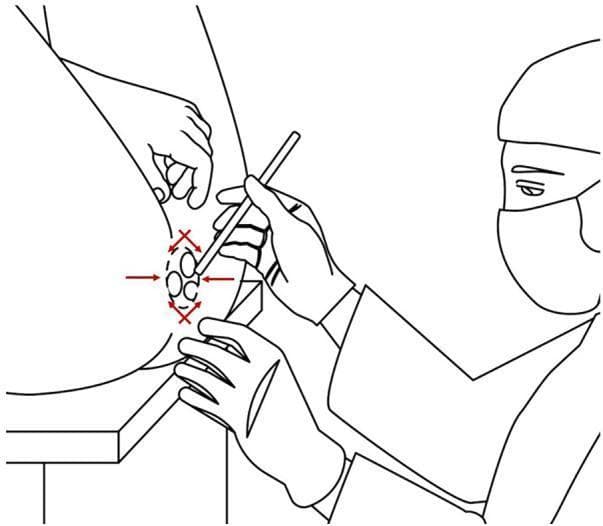 This medical illustration depicts a patient in the lithotomy position during a surgical hemorrhoidectomy. The diagram shows the patient’s hips flexed and legs elevated and abducted to provide optimal exposure of the perineum and anorectal region. A surgeon, wearing sterile gloves, a surgical mask, and a cap, is shown performing the procedure. One hand stabilizes the surgical site while the other holds a slender surgical instrument, likely for tissue dissection or local anesthetic infiltration. Red arrows and symbols overlaying the anal verge indicate the multi-quadrant nature of the hemorrhoidal lesions and the surgical approach for excision. This image serves as an educational resource for demonstrating perioperative patient positioning and the clinical setup for anorectal surgeries, highlighting the importance of anatomical access and sterile technique in a colorectal surgical context.