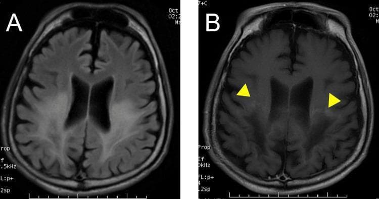 This diagnostic image set consists of two axial brain MRI scans from a 27-year-old male with adolescent cerebral-type adrenoleukodystrophy (ALD). Image (A) is a Fluid-Attenuated Inversion Recovery (FLAIR) sequence showing symmetric, diffuse, high-intensity signals in the posterior deep white matter, specifically involving the parieto-occipital lobes. This represents demyelination or vasogenic edema. Image (B) is a post-gadolinium contrast-enhanced T1-weighted sequence of the same region. It highlights linear border enhancement (indicated by yellow arrowheads) at the leading edges or anterior periphery of the white matter lesions. This peripheral enhancement is characteristic of active inflammatory demyelination and breakdown of the blood-brain barrier. These findings are clinically significant for monitoring disease progression in X-linked adrenoleukodystrophy, illustrating the classic radiographic 'zonal' pattern of the condition.