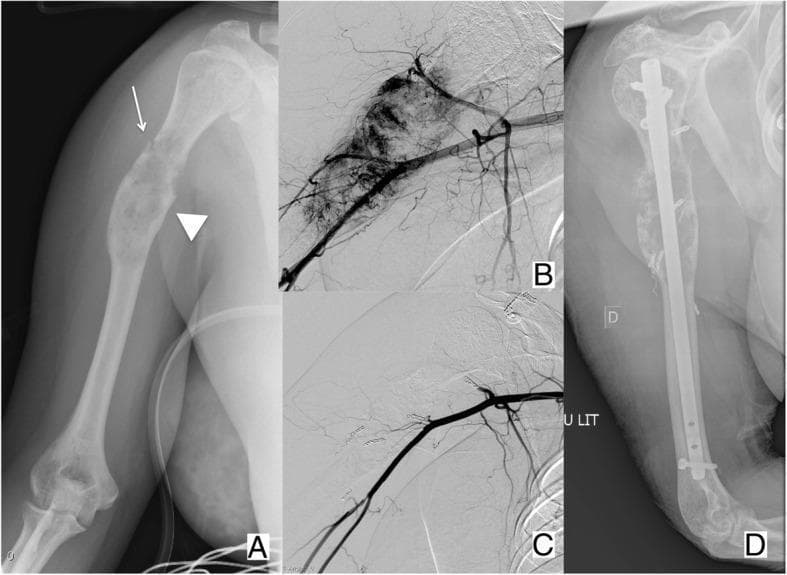 This composite figure illustrates the multi-modal diagnostic and therapeutic approach to a hyper-vascular bone metastasis in the right humerus. Panel A is an AP radiograph showing a lytic, expansive lesion in the proximal humeral diaphysis (arrowhead) secondary to renal cell carcinoma. A non-displaced pathologic fracture is identified by a thin white arrow. Panels B and C present digital subtraction angiography (DSA) images of the humeral region. Panel B demonstrates intense tumor blush and neovascularization, characteristic of a hyper-vascular metastasis. Panel C shows the same region post-transcatheter arterial embolization, revealing a significant reduction in vascular supply. Panel D is a post-operative radiograph demonstrating surgical fixation using an intramedullary nail with proximal and distal interlocking screws, providing mechanical stability to the pathologic fracture. This series highlights the clinical workflow of using pre-operative embolization to minimize intra-operative bleeding risk during the internal fixation of hyper-vascular metastatic bone disease.