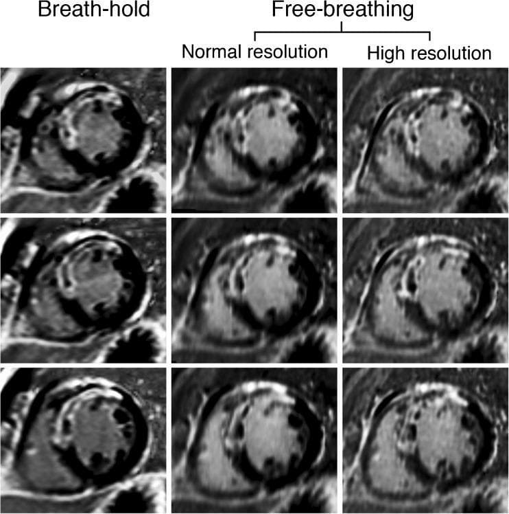 This diagnostic image set displays Late Gadolinium Enhancement Cardiac Magnetic Resonance (LGE-CMR) short-axis views of the left ventricle in a patient with ischemic cardiomyopathy. The 3x3 grid provides a side-by-side comparison of three acquisition techniques: breath-hold (left column), free-breathing normal resolution (middle column), and free-breathing high resolution (right column) across three different slices. The images demonstrate transmural LGE in the anteroseptal wall, indicative of a full-thickness myocardial infarction. A key clinical feature visualized is the presence of central dark areas within the hyperenhanced scar tissue, representing 'no-reflow' zones or microvascular obstruction. The comparison highlights the superior diagnostic clarity of the high-resolution free-breathing technique, which shows significantly sharper scar-to-myocardium borders and more defined internal morphology of the no-reflow zones compared to the blurrier margins seen in the breath-hold and normal-resolution acquisitions. This visual evidence supports the educational concept of improved scar edge sharpness (SES) through high spatial resolution imaging in cardiovascular radiology.