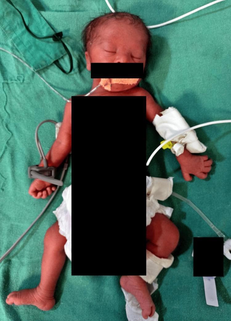 Clinical photograph of a neonate in a Neonatal Intensive Care Unit (NICU) setting, demonstrating characteristic dysmorphic features associated with Down syndrome (Trisomy 21). Visible craniofacial findings include up-slanting palpebral fissures, a depressed nasal bridge, a flattened facial profile, and small, dysplastic ears. The infant exhibits a short neck and relatively short extremities. Medical interventions are present, including an orogastric or endotracheal tube secured with tape at the mouth, a peripheral intravenous (IV) line bandaged on the left hand, and a pulse oximetry sensor attached to the right foot. The neonate is placed on a green sterile drape, illustrating a post-delivery clinical assessment or procedural context for respiratory distress management. The image serves as an educational reference for identifying neonatal syndromic markers and the typical presentation of hypotonia and joint laxity in a clinical setting.