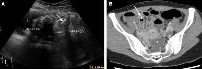 This dual-modality clinical image depicts acute perforated appendicitis in a 35-year-old female. Image A is a transverse abdominal ultrasound showing a dilated, non-compressible appendix adjacent to the right colon. A distinct hyperechoic focus with posterior acoustic shadowing is identified within the appendiceal lumen (arrow), characteristic of an intraluminal appendicolith. Image B is an axial contrast-enhanced CT scan of the pelvis, confirming the presence of a high-attenuation obstructive appendicolith (arrow). Key secondary findings of complicated appendicitis are present, including a significant fluid collection in the rectouterine pouch (cul-de-sac), marked with an asterisk, and generalized peritoneal enhancement. These findings are highly suggestive of appendiceal perforation and secondary peritonitis. The content is suitable for medical education regarding the radiological diagnosis of emergency gastrointestinal pathology, highlighting both sonographic and tomographic features of appendiceal obstruction and its complications.