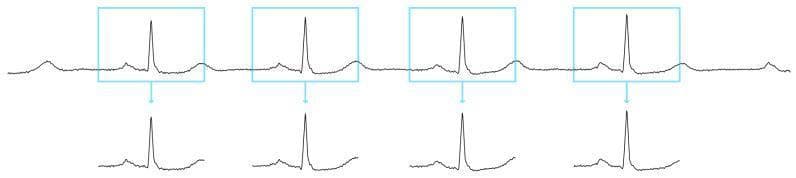 This diagnostic image illustrates the process of ECG signal preprocessing and heartbeat extraction for clinical analysis. The top portion of the diagram shows a continuous electrocardiogram (ECG) waveform containing a series of successive heartbeats. Four specific sections of this signal are demarcated by light blue rectangular windows, each centered on a prominent R-peak. Below the continuous trace, arrows point to isolated 600 ms segments corresponding to the boxed areas. Each isolated segment clearly displays the classic PQRST complex morphology: a low-amplitude P wave representing atrial depolarization, a high-amplitude R-peak indicating ventricular depolarization, and a broader T wave representing ventricular repolarization. This visualization demonstrates the segmentation technique used in automated ECG classification systems (such as those using the MIT-BIH database) to prepare individual heartbeats for algorithmic rhythm analysis. The uniform appearance of the extracted windows suggests a stable sinus rhythm, and the consistent windowing (108 samples before and after the peak) is a standard approach in biomedical signal processing for feature extraction and abnormal beat detection.