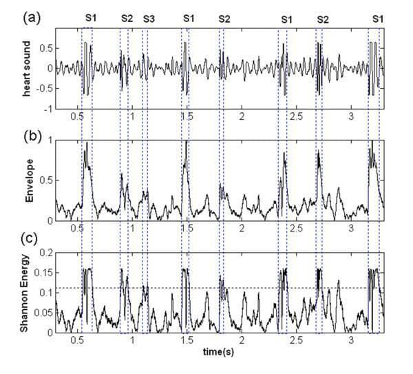 A comparison chart consisting of three vertically aligned signal processing plots (a, b, and c) derived from a human heart sound record (phonocardiogram) over a duration of approximately 3.5 seconds. Panel (a) displays the raw heart sound waveform showing characteristic periodic high-amplitude oscillations corresponding to the first (S1) and second (S2) heart sounds, with a labeled third heart sound (S3) visible in the early diastolic period following the first S2. Panel (b) illustrates the envelope of the signal, which traces the magnitude peaks of the cardiac cycle, smoothing the high-frequency oscillations into distinct pulses. Panel (c) shows the Shannon energy of the signal, a non-linear transformation used to emphasize low-amplitude components like S3 and S4. A horizontal dashed line in panel (c) represents a threshold level for signal detection and segmentation. Vertical blue dashed lines across all three panels correlate the temporal alignment of S1, S2, and S3 peaks. This visual is used to demonstrate diagnostic algorithms for heart sound segmentation and the identification of abnormal clinical signs.