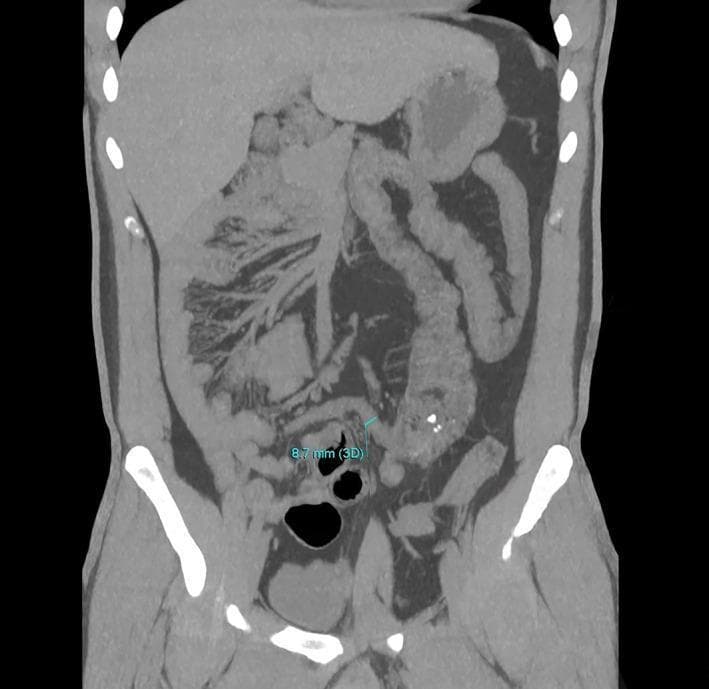 A coronal Computed Tomography (CT) reconstruction with Maximum Intensity Projection (MIP) demonstrating acute appendicitis in a patient with congenital intestinal malrotation. The diagnostic image shows the small bowel loops predominantly occupying the right side of the abdominal cavity and the colon localized to the left side, characteristic of malrotation. A dilated, fluid-filled appendix is clearly visible in an atypical location in the left mid-abdomen/periumbilical region, rather than the right iliac fossa. Electronic calipers measure the appendiceal diameter at approximately 8.7 mm, indicating inflammatory enlargement. Distinctive visual signs include wall thickening, internal fluid attenuation, and surrounding periappendiceal fat stranding (infiltration), which are hallmark features of appendicitis. This case highlights the clinical importance of radiological imaging in diagnosing common surgical conditions in patients with rare anatomical variations, where typical physical examination findings may be misleading due to visceral transposition.