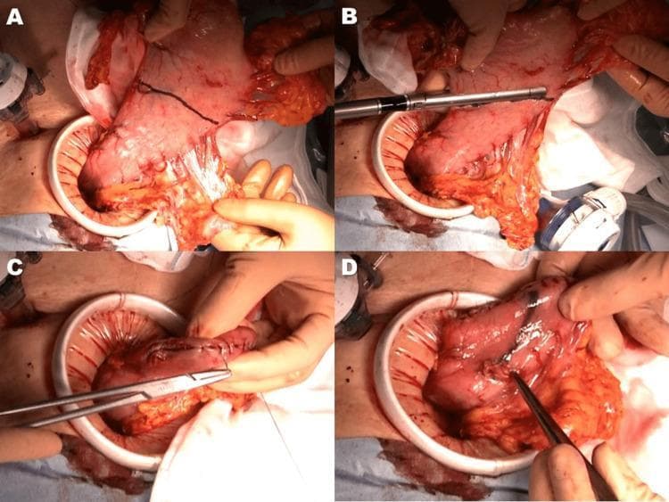 A series of four clinical photographs (A-D) demonstrating the intraoperative steps of a proximal gastrectomy and remnant stomach preparation. Panel A shows the stomach exteriorized through a mini-laparotomy incision, with the intended transection line marked across the corpus using Gentian Violet ink. Panel B illustrates the application of an endoscopic linear stapler along the marked line to achieve gastric transection. Panel C depicts the subsequent reinforcing of the stapled stump of the remnant stomach with seromuscular hand-sewn sutures using a needle driver. Panel D shows the creation of a small enterotomy on the anterior wall of the remnant stomach, located approximately 45 mm distal to the proximal stump, to facilitate subsequent esophagogastric reconstruction. The images highlight surgical techniques for gastric cancer management, focusing on resection margins and preparation for anastomosis. Key landmarks include the greater and lesser curvatures of the stomach and the surrounding omental tissue.