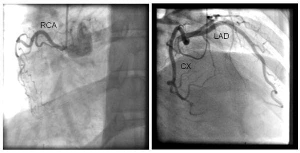 This diagnostic coronary angiogram consists of two panels demonstrating the anatomy of the coronary arterial tree. The left panel shows a hypoplastic right coronary artery (RCA), characterized by its small caliber and limited distal distribution. The right panel displays the left coronary system, including the left anterior descending (LAD) and circumflex (CX) arteries. The images reveal a left-dominant coronary circulation pattern, where the circumflex artery provides the primary blood supply to the posterior aspect of the heart. A notable finding is the marked tortuosity of the epicardial vessels, a feature often associated with chronic hypertension and arterial remodeling. Despite the tortuous course, there is no evidence of hemodynamically significant obstructive stenoses in the epicardial segments of the LAD, CX, or RCA. This study illustrates non-obstructive coronary artery disease in a patient with left-dominant anatomy and vessel tortuosity.