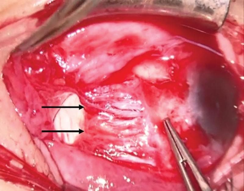 This intraoperative clinical photograph captures a surgical complication known as 'pulled-in-two syndrome' during strabismus surgery. The image shows the medial rectus (MR) muscle of the right eye, which has suffered a complete rupture at the muscle belly, approximately 5mm posterior to its scleral insertion. Two black horizontal arrows highlight the distal ruptured stump of the MR muscle. The surgical field displays exposed sclera and periocular connective tissue with visible focal hemorrhage and irrigation fluid. A pair of strabismus forceps is positioned in the lower right quadrant of the frame, currently manipulating the anterior segment of the muscle tissue. The image demonstrates the catastrophic failure of a contracted extraocular muscle under tension during a recession procedure, illustrating a rare but significant intraoperative risk in patients with high myopia or myopic strabismus fixus.