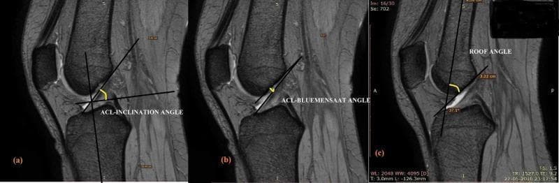 A composite of three sagittal T2-weighted MRI slices of a human knee joint, demonstrating the quantitative assessment of the anterior cruciate ligament (ACL) orientation and femoral morphology. (a) Illustrates the ACL-inclination angle, measured between a tangent line along the anterior aspect of the ACL and a line perpendicular to the longitudinal tibial axis. (b) Depicts the ACL-Blumensaat angle, defined as the angle formed between the Blumensaat line (the roof of the intercondylar notch) and the tangent to the anterior ACL fibers. (c) Displays the roof angle, which is the angle between the femoral longitudinal axis and the Blumensaat line, with an annotated value of 37.1 degrees. The images highlight key anatomical landmarks including the patella, distal femur, proximal tibia, and the fibrillar structure of the ACL. These measurements are clinically relevant in orthopedics for evaluating ACL graft placement, impingement risk, and native ligament biomechanics.