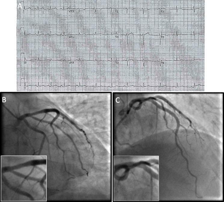 A multi-panel medical diagnostic image set for a cardiology case study. Panel A displays a standard 12-lead Electrocardiogram (ECG) recorded on standard grid paper. The tracing shows leads I, II, III, aVR, aVL, aVF, and precordial leads V1-V6. The ECG exhibits a sinus rhythm with subtle ST-segment changes, relevant for evaluating acute coronary syndrome. Panels B and C are invasive coronary angiograms of the left coronary system. Panel B shows a Right Anterior Oblique (RAO)-caudal view, providing a detailed visualization of the circumflex artery and the proximal Left Anterior Descending (LAD) artery. Panel C presents an Anterior-Posterior (AP)-cranial view, optimized for viewing the mid-to-distal LAD and its diagonal branches. Both angiographic panels include magnified insets focusing on the proximal LAD to assess for subtle atherosclerotic plaques or luminal irregularities. This figure illustrates the clinical workup for a patient presenting with chest pain and elevated troponins, emphasizing the correlation between electrical heart activity and vascular imaging.