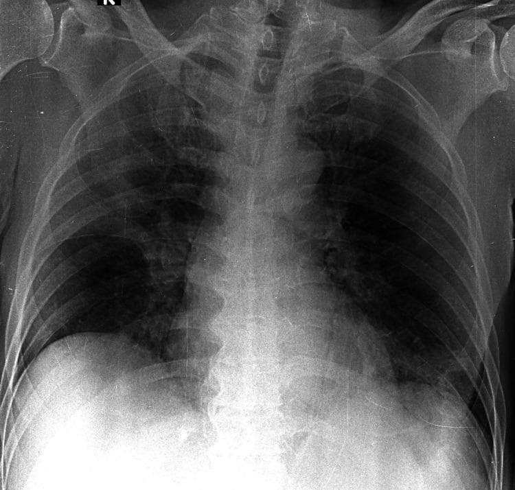 This diagnostic image is an anteroposterior (AP) chest X-ray of a patient with moderate SARS-CoV-2 (COVID-19) pneumonia. The radiograph demonstrates multi-focal areas of increased pulmonary opacity with an atypical, non-uniform distribution. Specifically, there is focal consolidation visible in the right upper lobe and the left basal zone. The right peripheral lower zone exhibits ground-glass opacities (GGO), characterized by hazy increases in lung density that do not obscure the underlying bronchovascular structures. The cardiac silhouette and mediastinal contours appear within normal limits. Clinically, this imaging illustrates moderate disease severity based on standardized scoring systems (Brixia, RALE, and mCXR), where the bilateral involvement of different lung zones reflects typical viral pneumonia patterns but with specific regional consolidation. The educational focus is on identifying diverse parenchymal infiltrates associated with COVID-19, ranging from ground-glass patterns to dense consolidations.