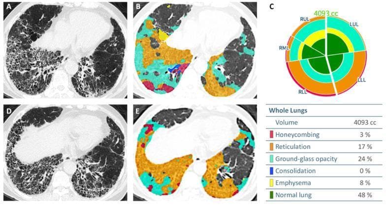 This composite image illustrates the automated quantification of CT parenchymal patterns in a 74-year-old male with Idiopathic Pulmonary Fibrosis (IPF). Figures A and D display axial thin-section High-Resolution Computed Tomography (HRCT) images at the lung bases, showing classic signs of interstitial lung disease: peripheral honeycombing, reticulation, and ground-glass opacities (GGO). Figures B and E show the same HRCT slices with color-coded overlays generated by AI for disease pattern classification. The color map identifies honeycombing (red), reticulation (orange), ground-glass opacity (cyan), emphysema (yellow), and consolidation (dark blue), with normal lung tissue in dark green. Figure C includes a quantitative circular glyph and table summarizing the whole-lung volume (4093 cc). The data highlights the extent of lung involvement: 48% normal lung, 24% GGO, 17% reticulation, 8% emphysema, and 3% honeycombing. The glyph further breaks down these proportions by lung lobe (RUL, RML, RLL, LUL, LLL), facilitating an objective assessment of disease distribution and severity for clinical monitoring and research.