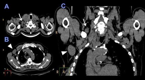This diagnostic imaging composite displays contrast-enhanced Computed Tomography (CT) scans of the neck, chest, and shoulder regions in axial (a, b) and coronal (c) planes. The images demonstrate significant pathological findings characteristic of metastatic disease, specifically involving the lymphatic system. In the axial view at the level of the lower neck (a), a white arrow identifies an enlarged, heterogeneously dense lymph node in the right supraclavicular fossa. Further inferiorly in the axial chest view (b), a white arrowhead indicates a prominent, rounded, and enlarged lymph node in the right axilla. The coronal reconstruction (c) provides a comprehensive view of both regions, highlighting the spatial relationship and abnormal morphology of the supraclavicular (arrow) and axillary (arrowhead) lymphadenopathy. These findings are clinically consistent with regional lymph node metastasis, as seen in cases of advanced primary thyroid carcinoma. The images serve as an educational example of oncological staging and the identification of distant nodal involvement in head and neck malignancies.