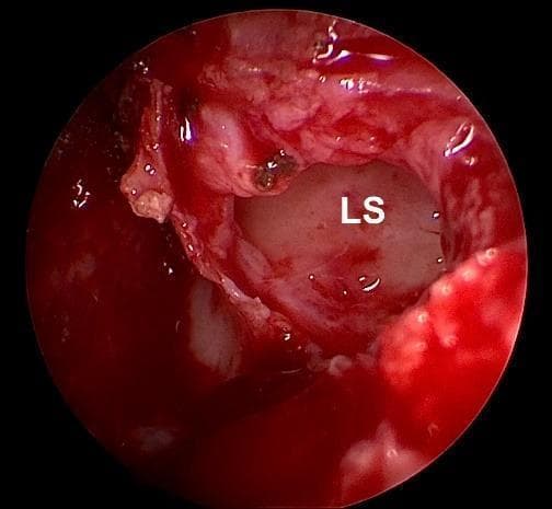 This endoscopic clinical photograph depicts an intraoperative view during an endonasal dacryocystorhinostomy (DCR). The focal point is a wide, circular marsupialization of the lacrimal sac (LS), indicated by the label. The interior mucosa of the lacrimal sac appears pale, smooth, and whitish, contrasting with the surrounding hyperemic and vascularized nasal mucosa. The surgical field shows active but controlled bleeding and moist tissues, typical of an endonasal procedure. The anatomical region shown is the lateral nasal wall where the lacrimal bone and frontal process of the maxilla were removed to expose the sac. This image demonstrates a successful surgical opening that is sufficiently large to maintain patency without the need for silicone stenting. Key educational concepts include lacrimal system anatomy, surgical management of nasolacrimal duct obstruction, and endoscopic visualization techniques in otolaryngology and ophthalmology.